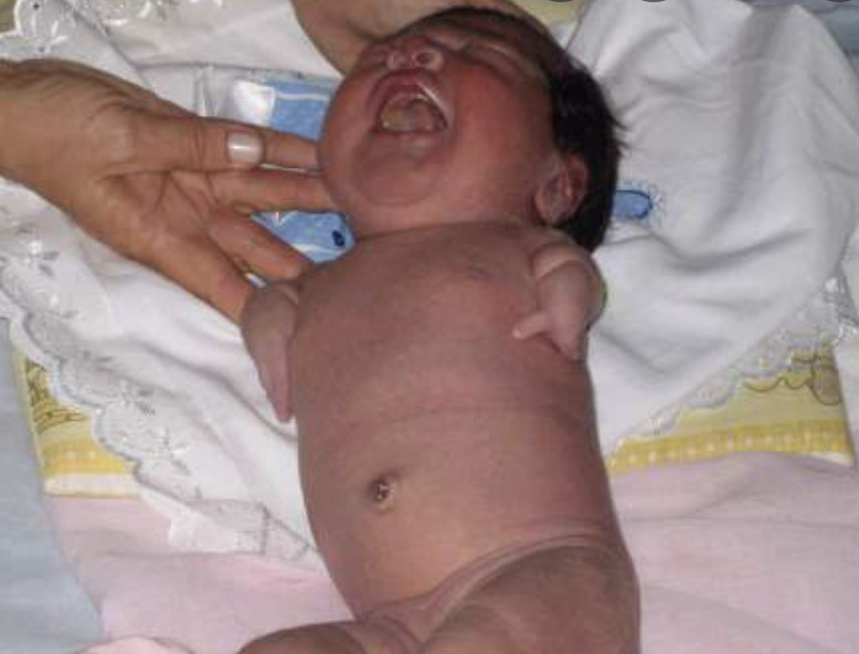 Bambino focomelico per la talidomide Bambino focomelico talidomide